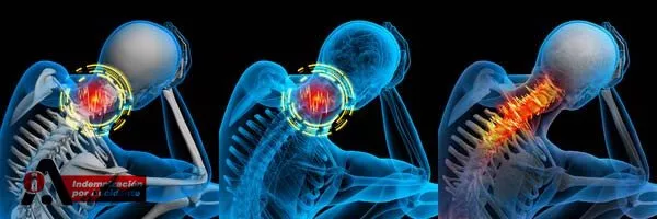 esguince cervical en accidentes de trafico