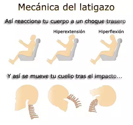 mecanismo del latigazo cervical