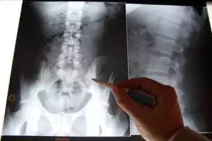 Detalle de una radiografía de columna vertebral